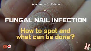 FUNGAL NAIL infection How to spot and What can be done [upl. by Zach]