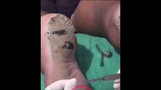 Satisfying Callus Removal shorts callus [upl. by Vasyuta]