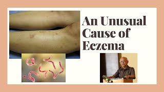 An unusual cause of eczema  Hookworm dermatitis [upl. by Rutledge]