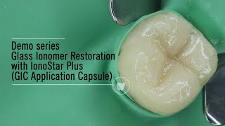 IonoStar Plus VOCO  Glass Ionomer Restoration  GIC Application Capsule [upl. by Nyrahs505]