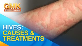 Cause and treatment for urticaria or hives  Usapang Pangkalusugan [upl. by Ozneral759]