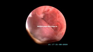 Hysteroscopic Polypectomy for Multiple Polyps I Dr Rajeev Agarwal [upl. by Nnylsaj]