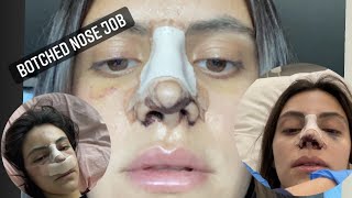 WOKE UP BOTCHED FROM SURGERY my botched nose job journey PART 1 [upl. by Levania]