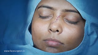 Scar Removal on Nose  Deep Scar Removal With Before and After Results [upl. by Luella]