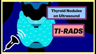 Is my thyroid nodule cancer thyroid radiology ultrasound [upl. by Salvatore]