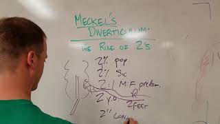 Meckels Diverticulum The Rule of 2s [upl. by Risa]