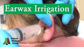 Ear Wax Irrigation  Auburn Medical Group [upl. by Eilsehc]