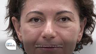 Plexaderm Helps Reduce UnderEye Bags and Wrinkles in Minutes  Cincy Lifestyle [upl. by Norton]