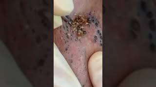 Elderly Blackhead Removal blackheads acne elderly pimplepopping whiteheads satisfying asmr [upl. by Pate]