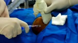 innominate vein cannulation [upl. by Cumine]