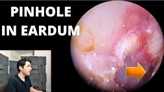 Pinhole Eardrum Perforation With White Fungal Growth In Canal [upl. by Matilda]