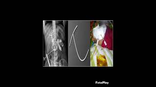 TTUBE CHOLANGIOGRAPHY DIAGRAM [upl. by Donnenfeld]