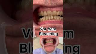 Bleaching in 1 Minute demonstriert  anhand von Dr Grimmels eigenen Zähnen [upl. by Caldeira]