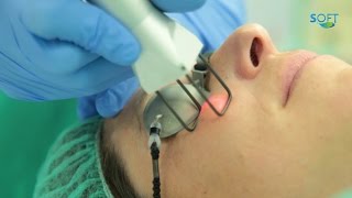 Blefaroplastia laser [upl. by Rigby331]