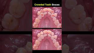 Complex braces for crowded teeth braces orthodontist dentist [upl. by Crim]