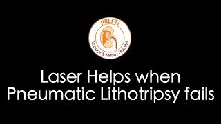 Laser Helps when Pneumatic Lithotripsy fails [upl. by Weibel]