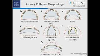 1124 Excessive Dynamic Airway Collapse An Introduction [upl. by Ahsiekan621]