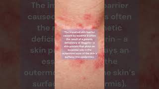 What is Eczema Atopic Dermatitis  Skin Type Solutions [upl. by Nico328]