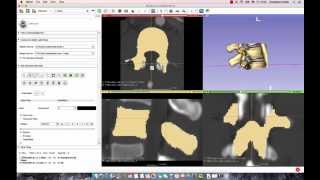 3D Slicer Tutorial How to Segment a Lumbar Vertebrae [upl. by Arrek]