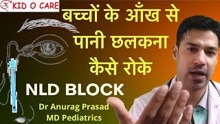 Watering Eyes in Babies  Nasolacrimal Duct Massage  NLD Block Treatment  Dr Anurag Prasad vlog4 [upl. by Atrice182]