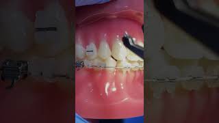 Orthodontics and Braces Improving Teeth Alignment [upl. by Eislek]