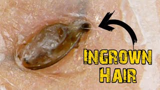 Ingrown Hair Removal x Satisfying Blackheads [upl. by Nahgen]