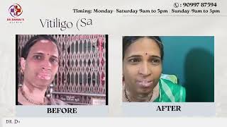 Restoring Pigment Effective Treatment for Vitiligo at Dr Danial’s Clinic [upl. by Bonina]