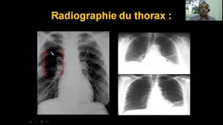 Embolie pulmonaire Dr Khacha Cardio  Quatrième Année Médecine [upl. by Trojan375]