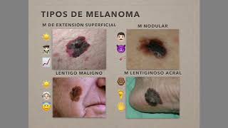 Melanoma [upl. by Aleydis]