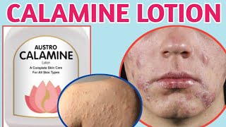 Calamine lotion  calamine lotion uses  calamine lotion uses in hindi [upl. by Migeon]