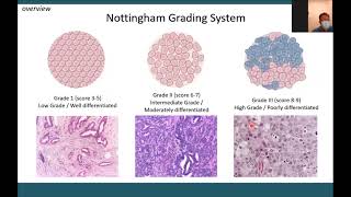 Grading Assesment for Breasst Cancer and its Clinical Application  Surabaya [upl. by Mall207]