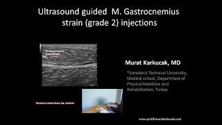 Ultrasound guided M Gastrocnemius strain grade 2 injections [upl. by Cita119]