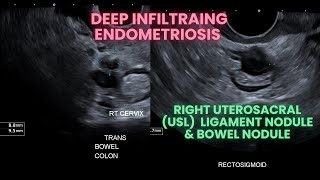 Ultrasound Deep infiltrating endometriosis Bowel nodule and uterosacral ligament nodule [upl. by Ausoj]