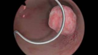 Polypectomy  Polyp Removal  Virtual Reality Simulation for Endoscopic Surgery [upl. by Yrok]