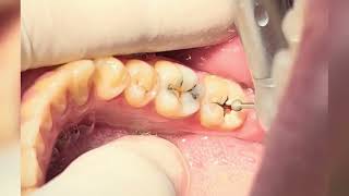 Teeth Composite Restoration After Deep Caries Cleaning [upl. by Aerdma]