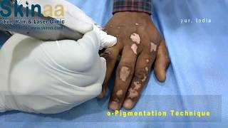 Vitiligo or Leucoderma Treatment Micropigmentation in India  Safed Daag Ka Ilaj │Skinaa Clinic [upl. by Kedezihclem334]