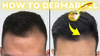 How to Derma Roll for Quickest Hair Results StepbyStep Guide [upl. by Ydnec998]