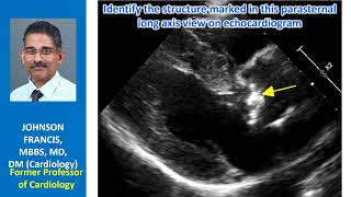 Identify the structure marked in this parasternal long axis view on echocardiogram [upl. by Hanna]