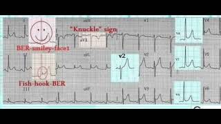 pericarditis or BER on ECG [upl. by Mcarthur740]