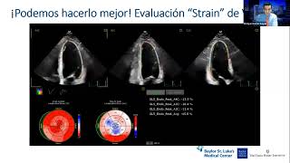 Webinar FAC Estenosis aórtica moderada y severa asintomática ¿son todas iguales [upl. by Annekam]