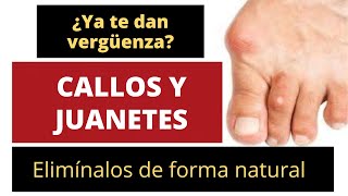 ¿YA TE DAN VERGÜENZA LOS CALLOS Y LOS JUANETES ELIMÍNALOS DE FORMA NATURAL [upl. by Sutton44]