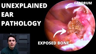 Benign Necrotising Otitis Externa 3 cases [upl. by Wescott]