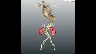 Disección de Aorta ToracoAbdominal por Tomografía Computarizada [upl. by Gentille]