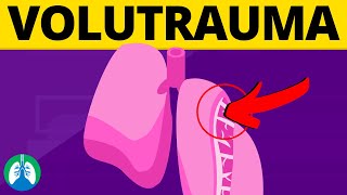 Volutrauma Medical Definition  Quick Explainer Video [upl. by O'Neill341]