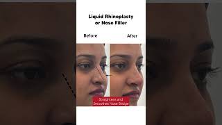 Nose Filler Or Liquid Rhinoplasty  Berkowits Clinic fillers [upl. by Berns]