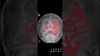 ENT Ospe Xray of Paranasal sinuses part01ENTDrTayyibaarshad [upl. by Elatsyrc]