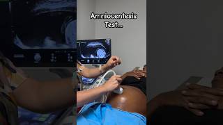 Amniocentesis Test Processes … Amniotic fluid from abdomen to rule out congenital defect [upl. by Ahtera]