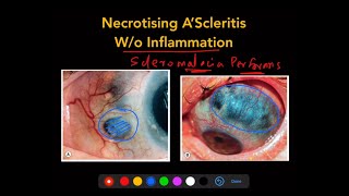 Scleritis  The Complete Course [upl. by Frum]