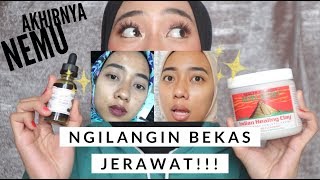 PENGALAMAN NGILANGIN BEKAS JERAWAT  Savera Helena [upl. by Annahc340]