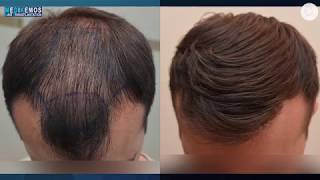 FUE 3027 Fu´s Dr Lupanzula MeDiKemos ENG hairtransplant [upl. by Sirromal993]